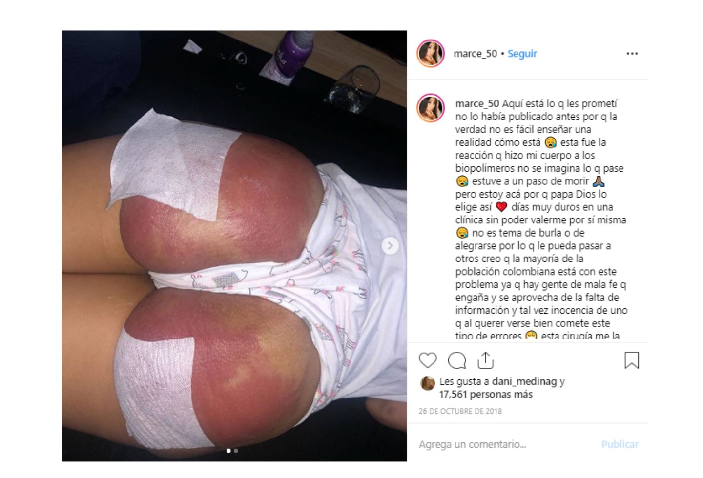 La DJ Marcela Reyes así contó su tragedia con los biopolímeros.