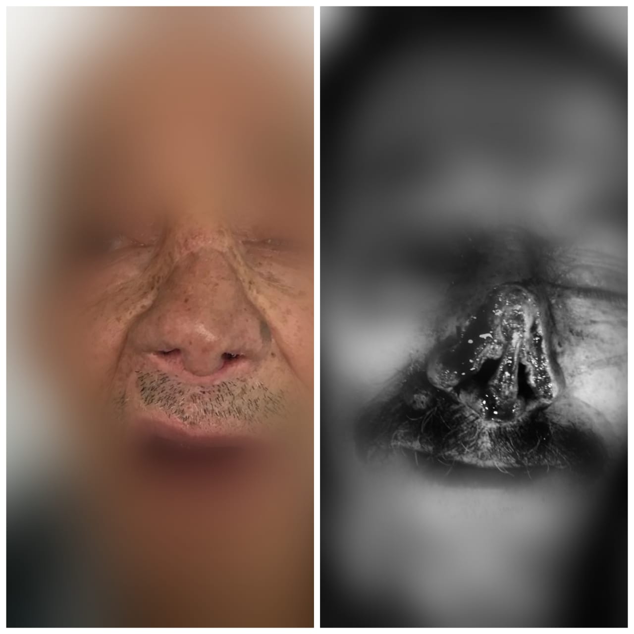 Reconstrucción de nariz