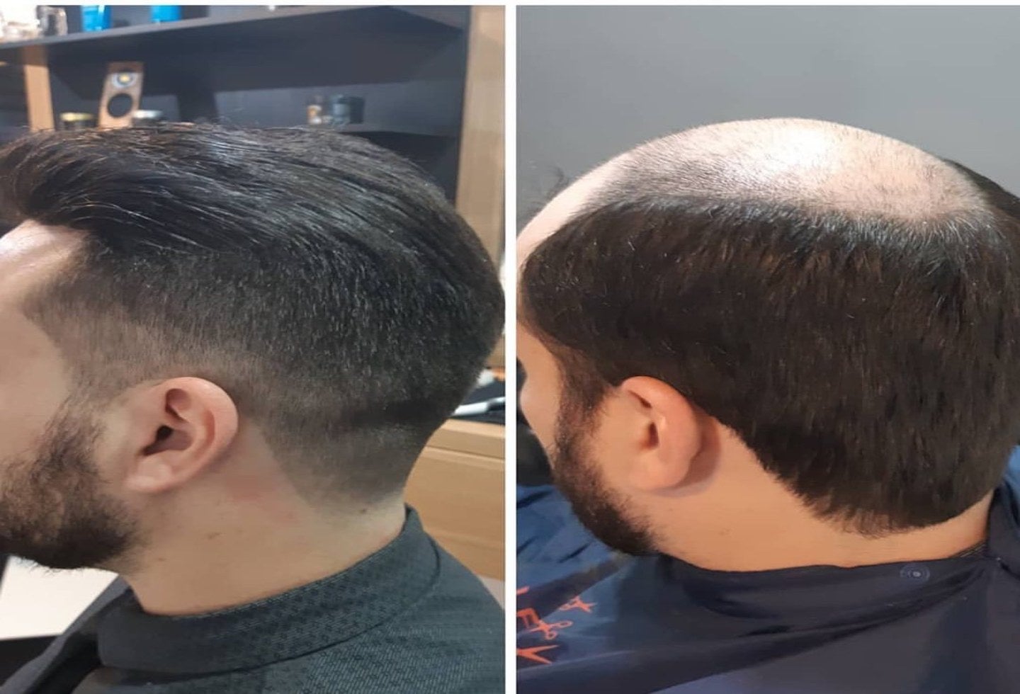 Exceso de trabajo podría llevarlo a la calvicie