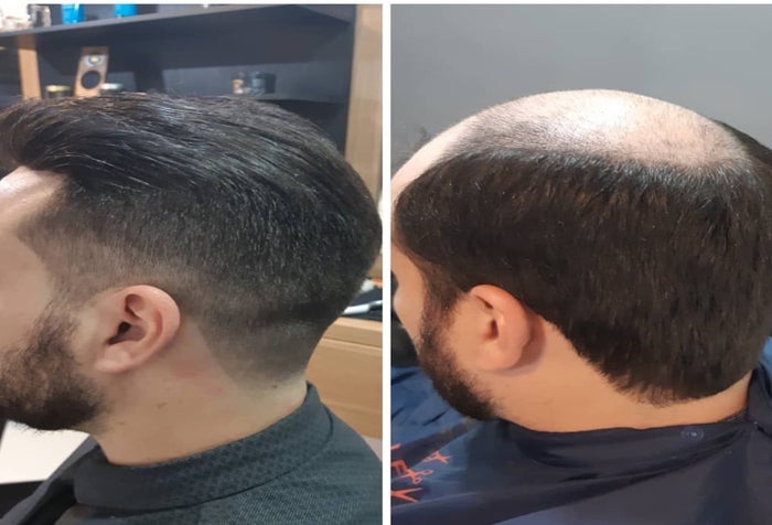 Exceso de trabajo podría llevarlo a la calvicie