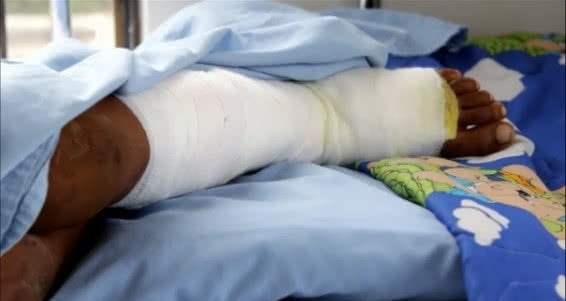 Quemados con pólvora