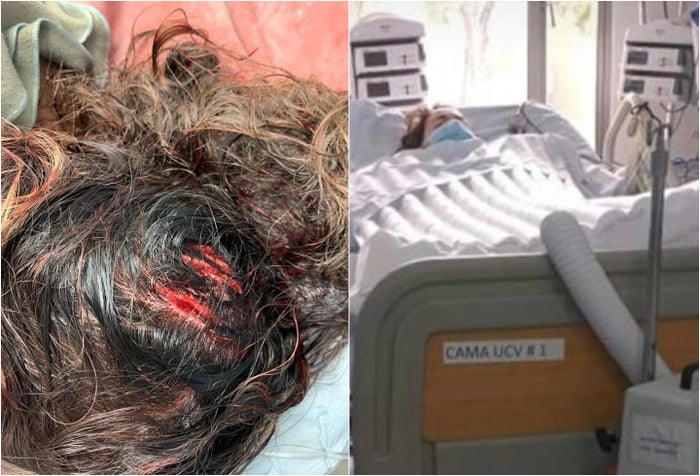 Delante del hijo de ella, hombre atacó con un hacha en la cabeza a su pareja en Bogotá