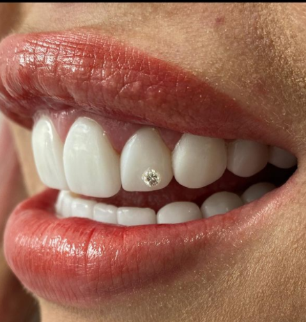 Yina Carlderón estrena diamante en su diseño de sonrisa