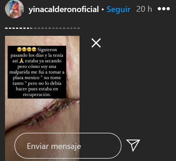 Cirugía a Yina Calderón