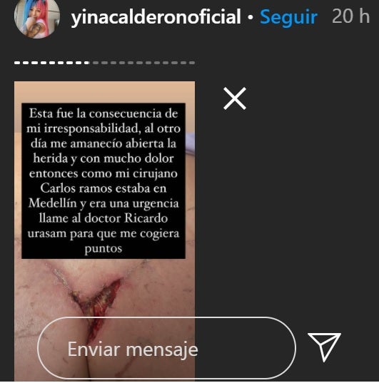 Cirugía a Yina Calderón