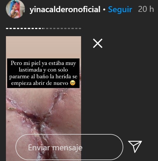 Cirugía a Yina Calderón