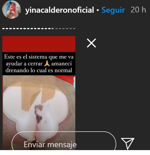 Cirugía a Yina Calderón