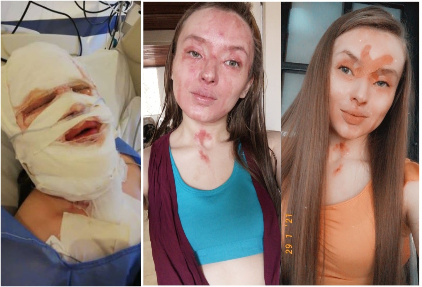 Joven atacada con ácido en Bogotá