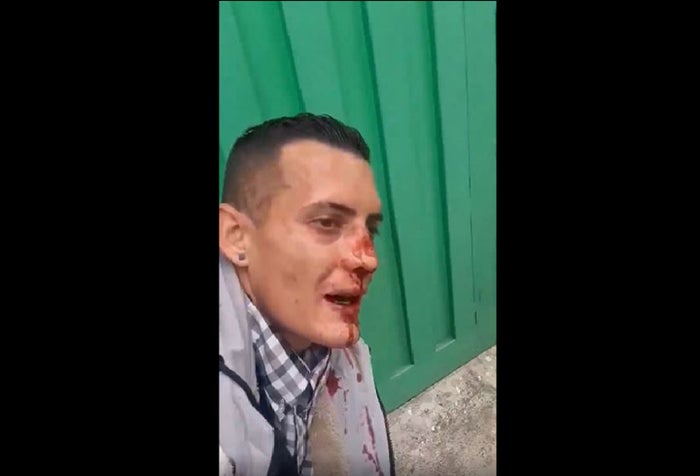 Le rompieron la nariz a ladrón de Suba