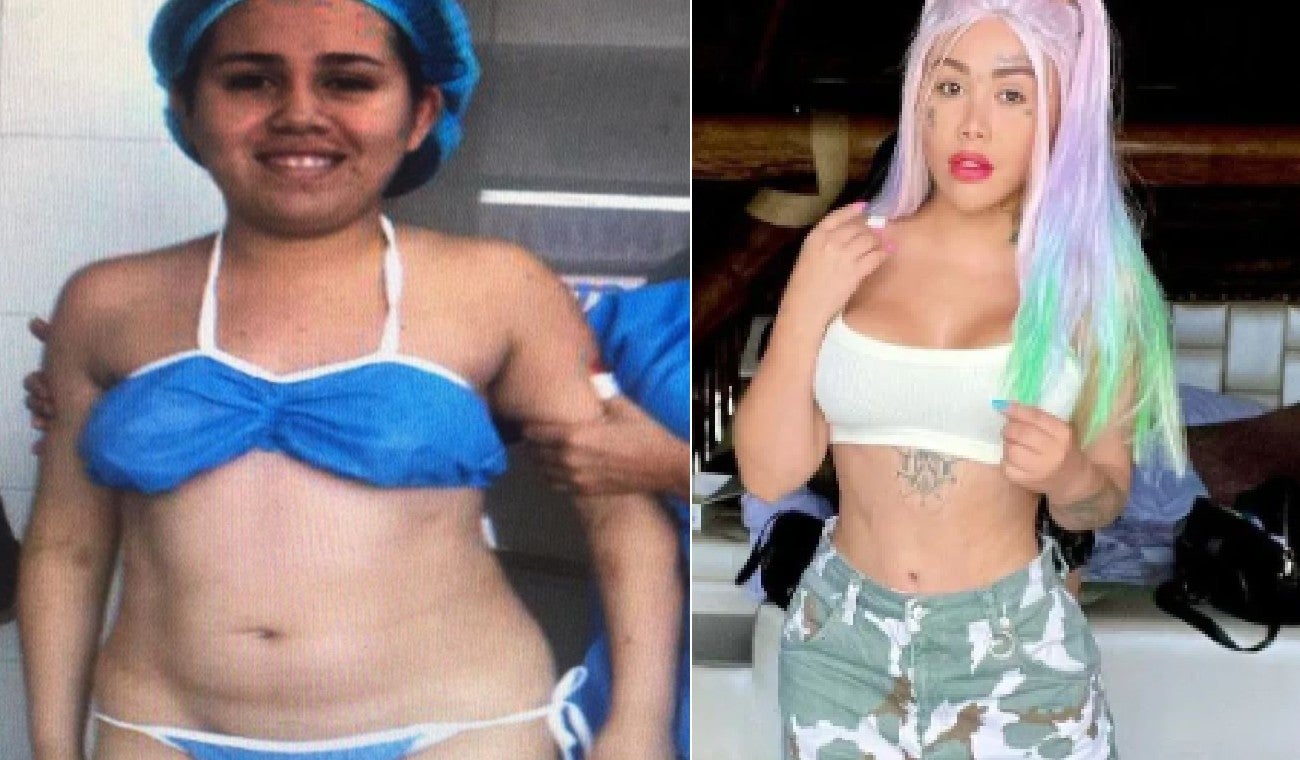 Yina Calderón Cirugías Estéticas