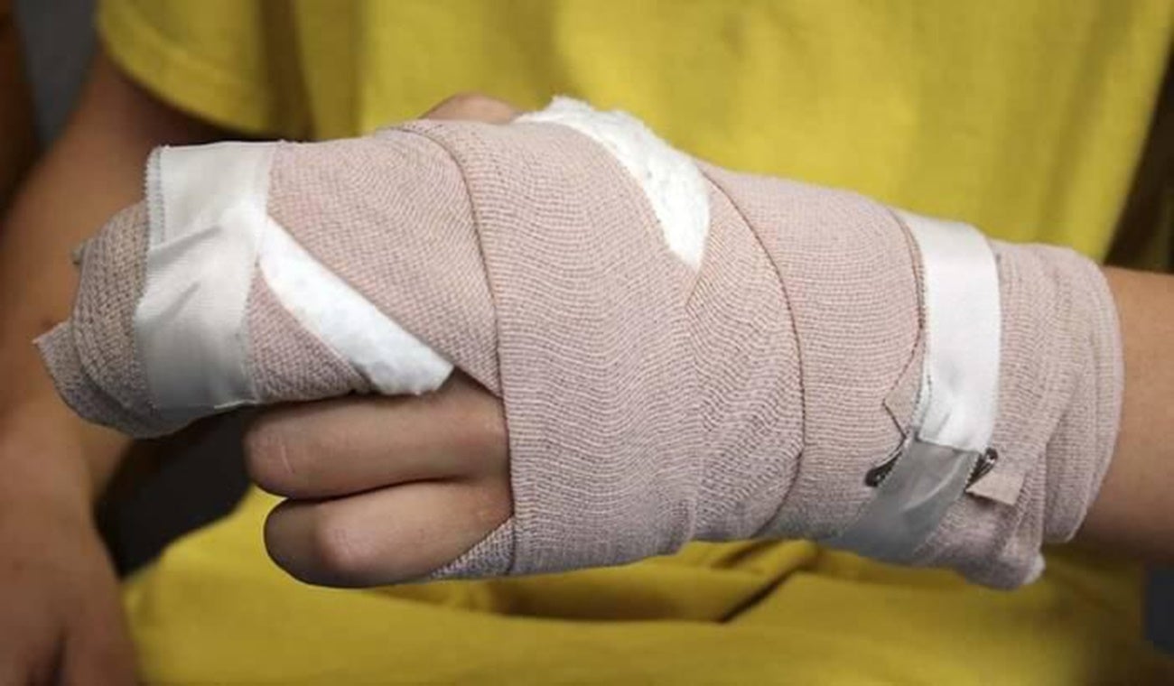 Quemaduras por pólvora