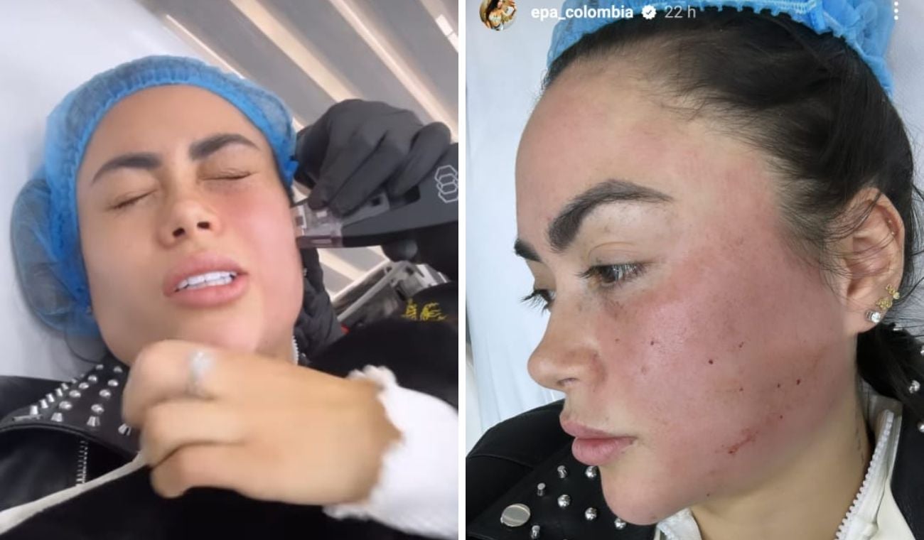 Epa Colombia en procedimiento estético