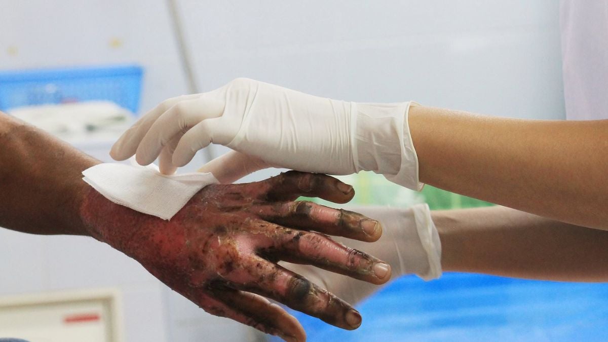 Cifras de quemados por pólvora en Colombia