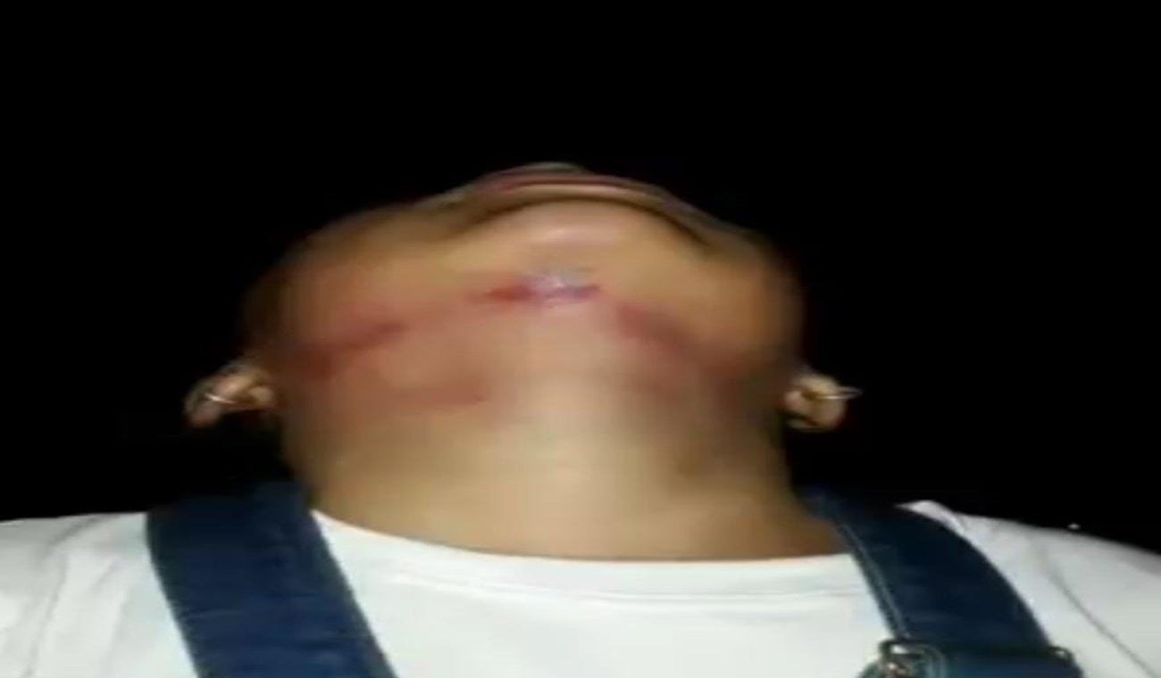 Niña heridas en su cuello Mariquita