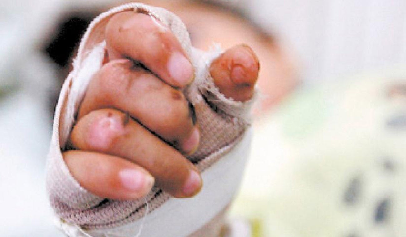 Referencia quemadura.