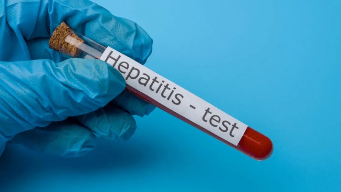 Hepatitis en Cartagena