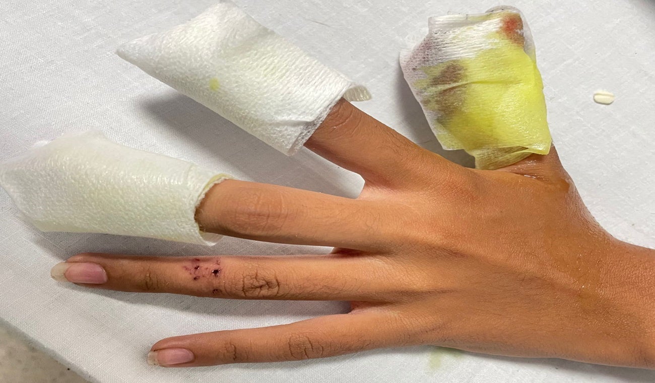 Quemaduras por pólvora en menor de 16 años