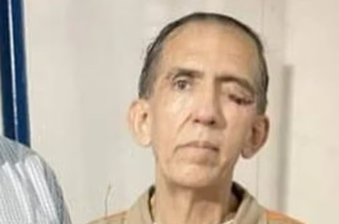 Luis Alfredo Garavito tenía un ojo carcomido por una verruga cancerígena