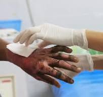 Son 698 los afectados con este químico peligroso