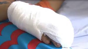 Niña de 3 años quemada con pólvora