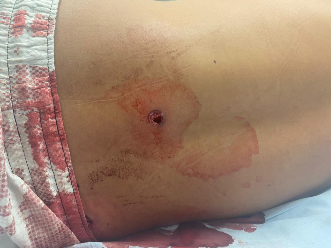 Joven sobrevivió a tres disparos en un intento de hurto en Bello, Antioquia