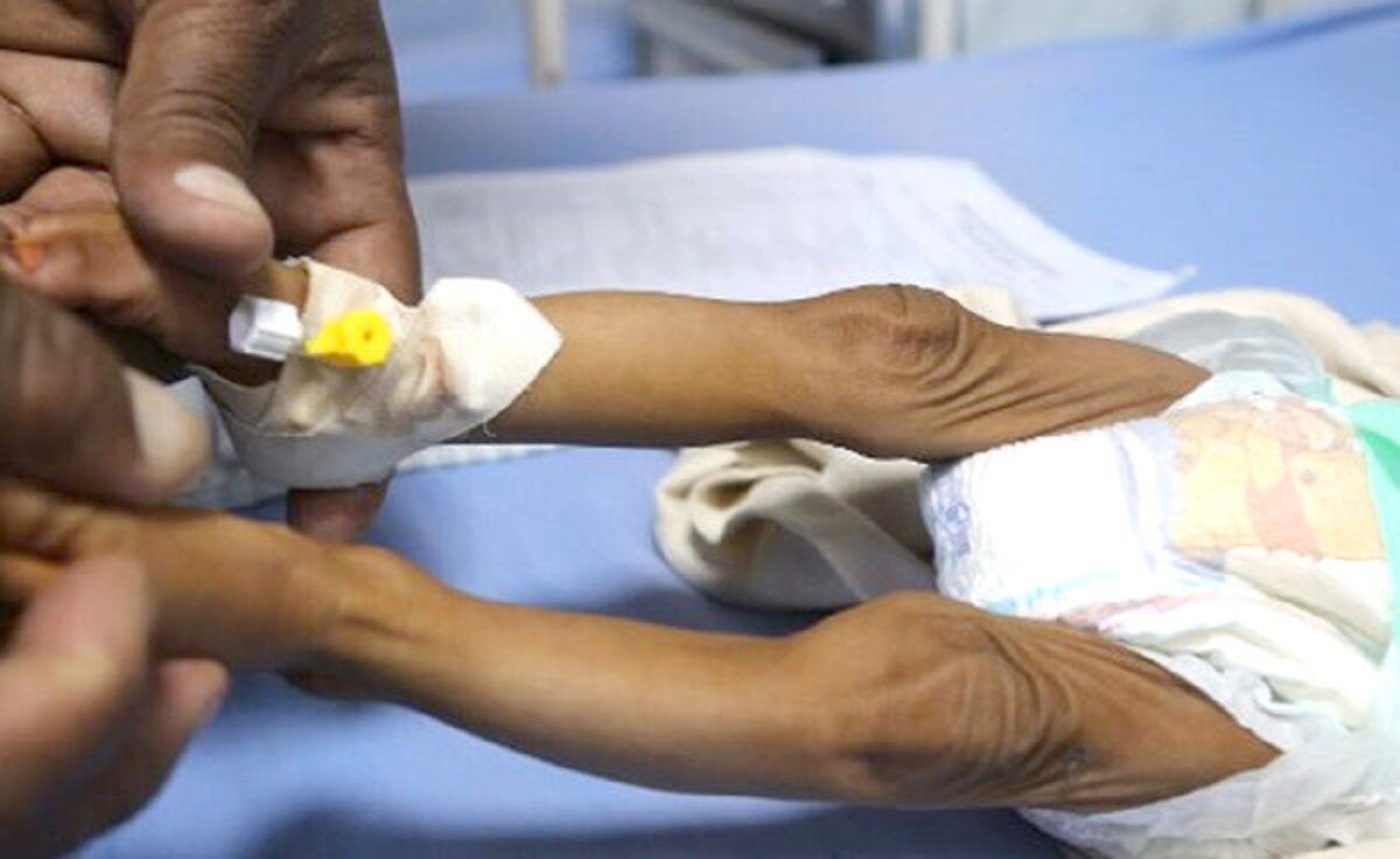 Niños mueren por desnutrición - referencial