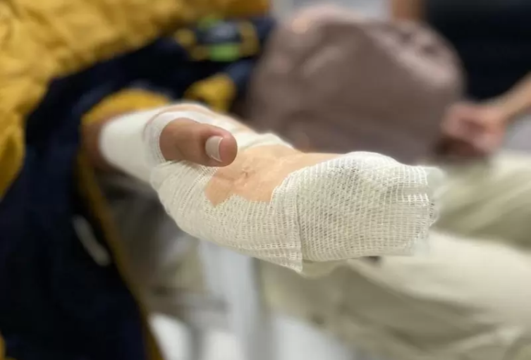 Noticias de quemados