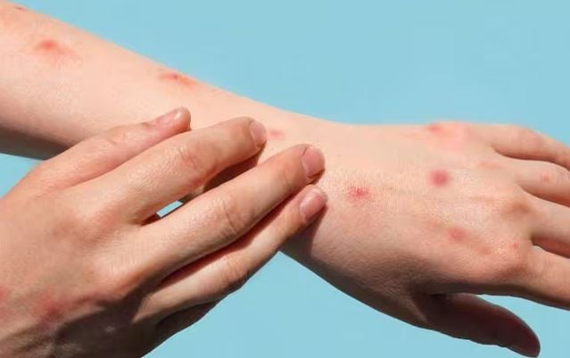 Denuncian negligencia en la cárcel de Puerto Triunfo: 11 reclusos más expuestos a varicela en patio aislado