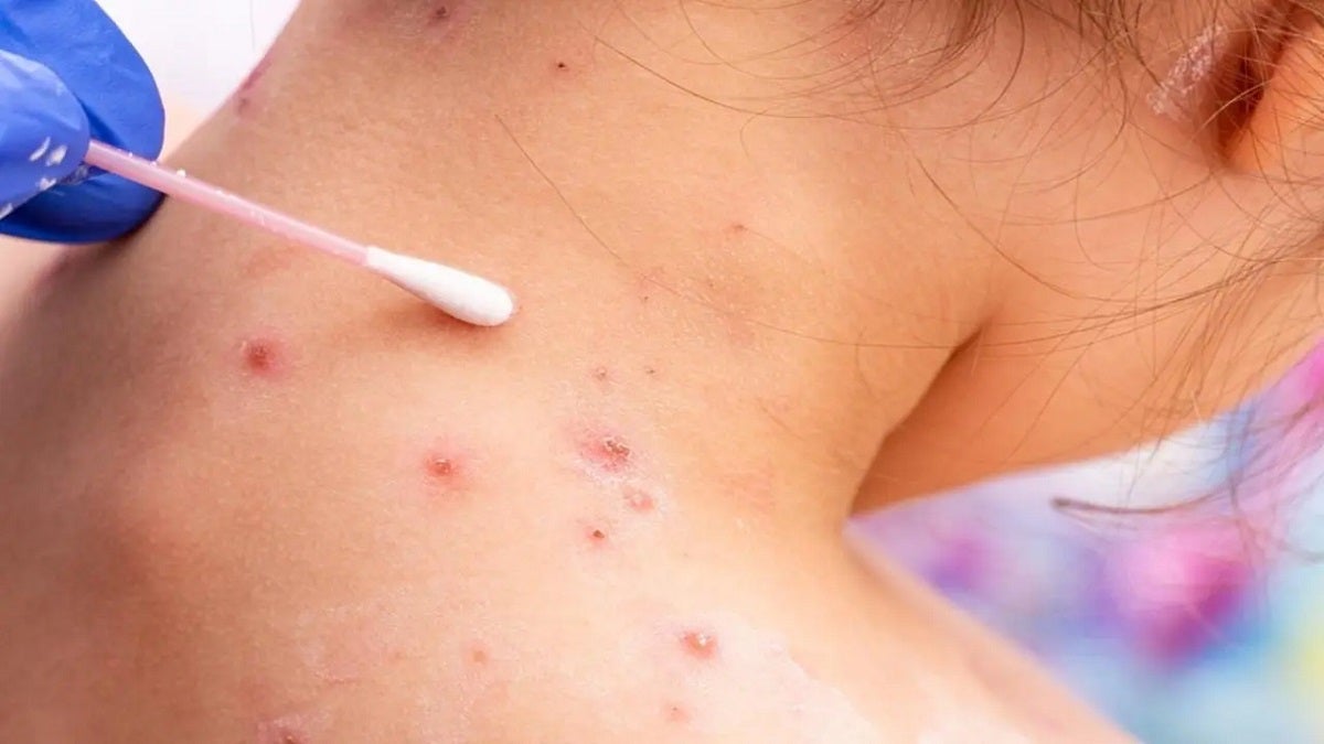 Utilizar preservativo durante las relaciones sexuales es una de las recomendaciones de la Alcaldía de Medellín