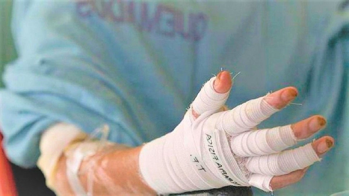 A 95 aumentó la cifra de personas quemadas con pólvora en Antioquia