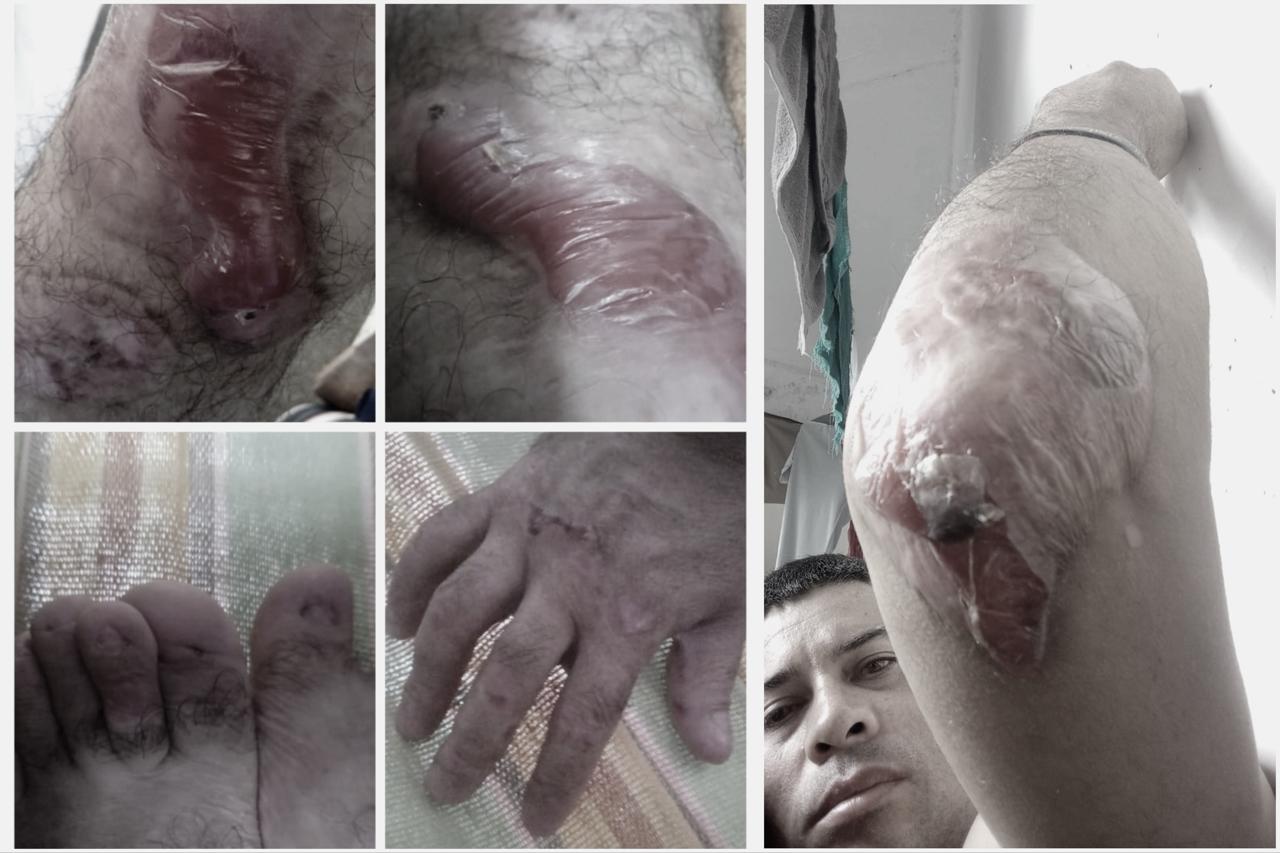 Drama en cárcel antioqueña: Recluso con ‘Piel de Mariposa’ sufre por condiciones inhumanas