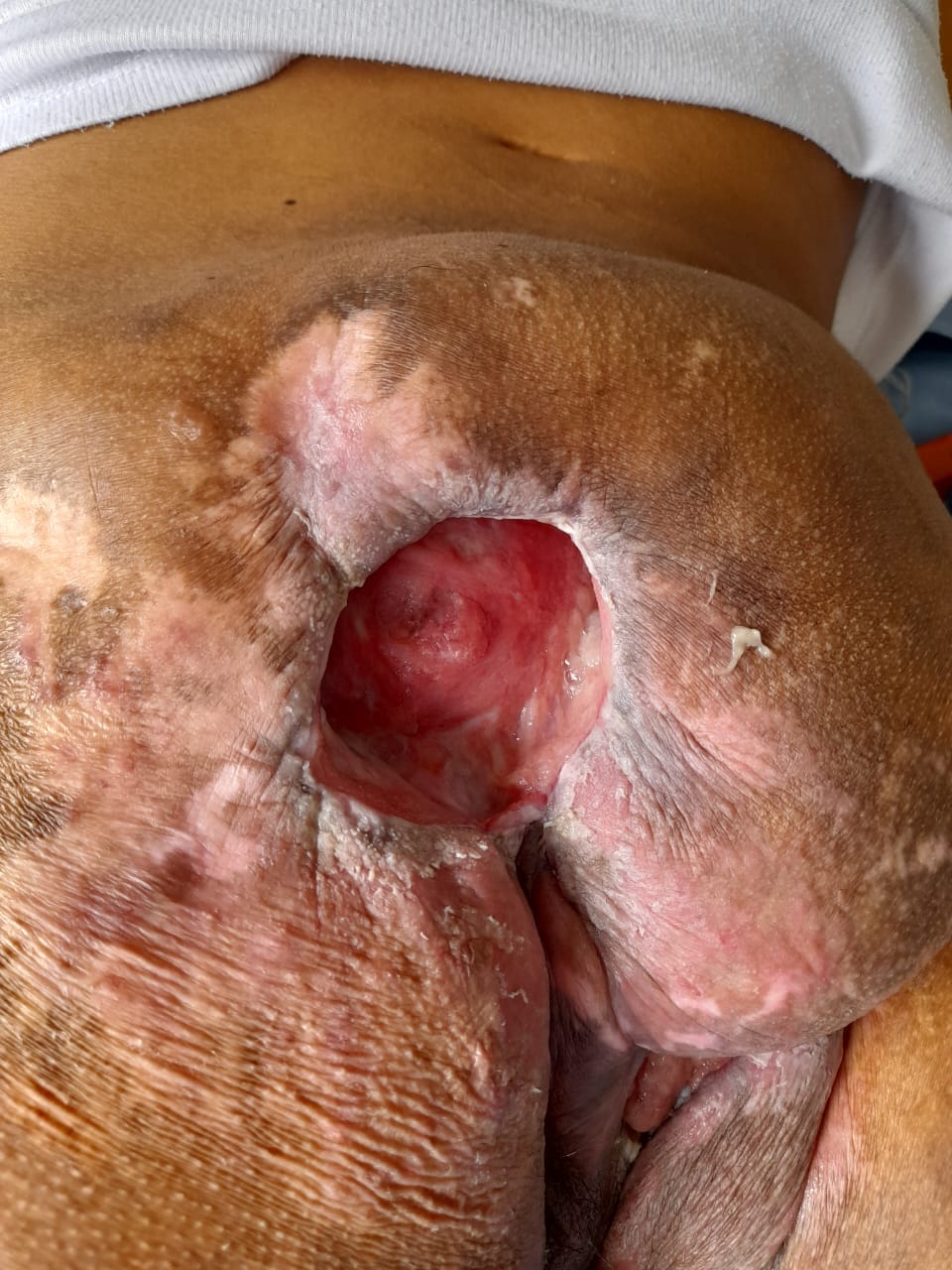 Con heridas abiertas, sin curaciones ni tratamiento: caso crítico de salud en prisión domiciliaria en Copacabana