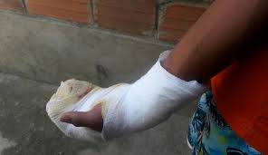 Quemados con pólvora en Norte de Santander