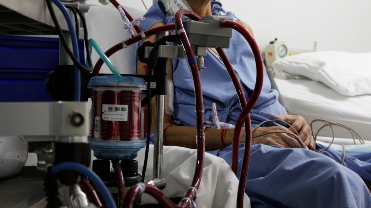 Alerta por escasez de sangre para pacientes con terapia ECMO en Santander