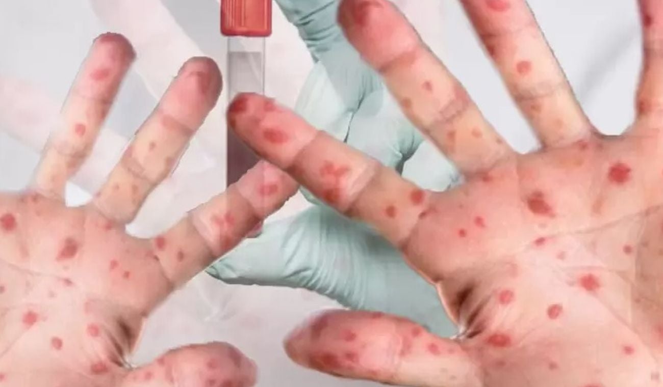 viruela mono santander