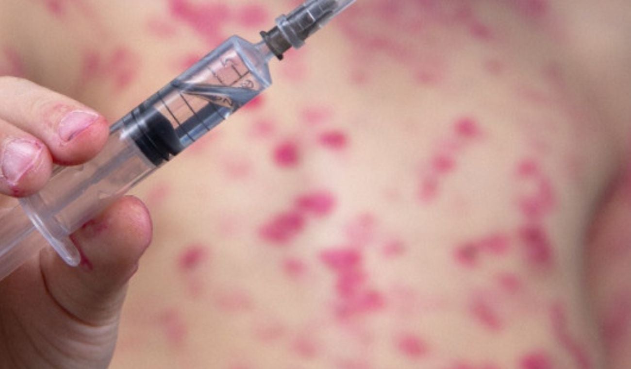 viruela símica Santander