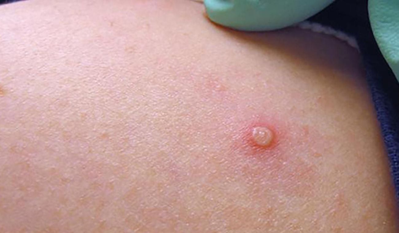 viruela del mono Santander