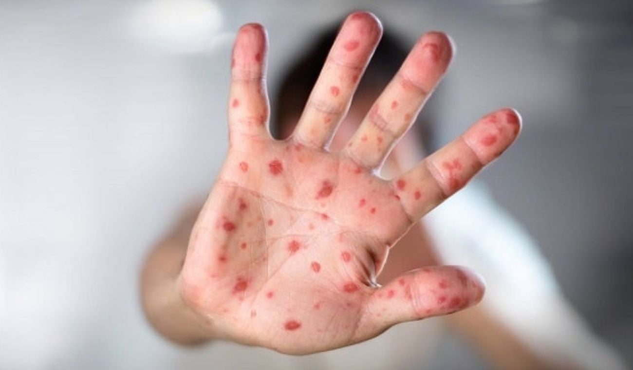 El primer caso de viruela del mono enciende las alertas en Barrancabermeja.