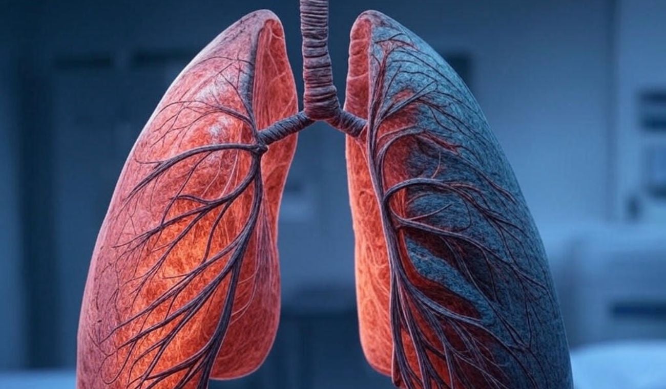 Pulmones afectados por tuberculosis (referencia)