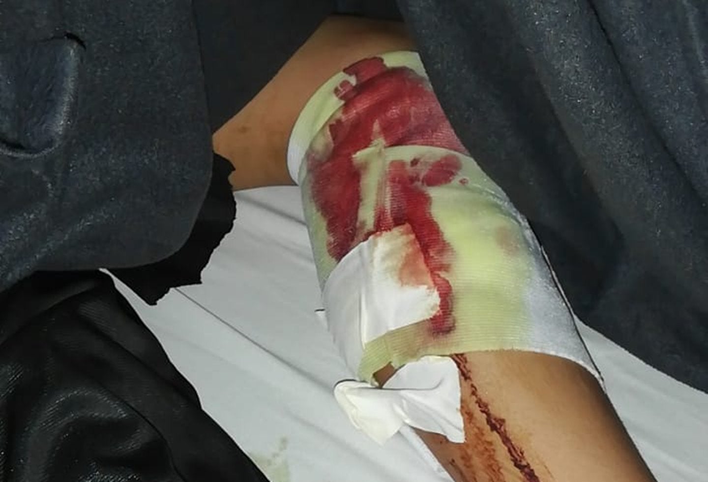 ¡Conciencia! Perro Pitbull mordió a un menor en la Ciudadela Bolívar de Ibagué