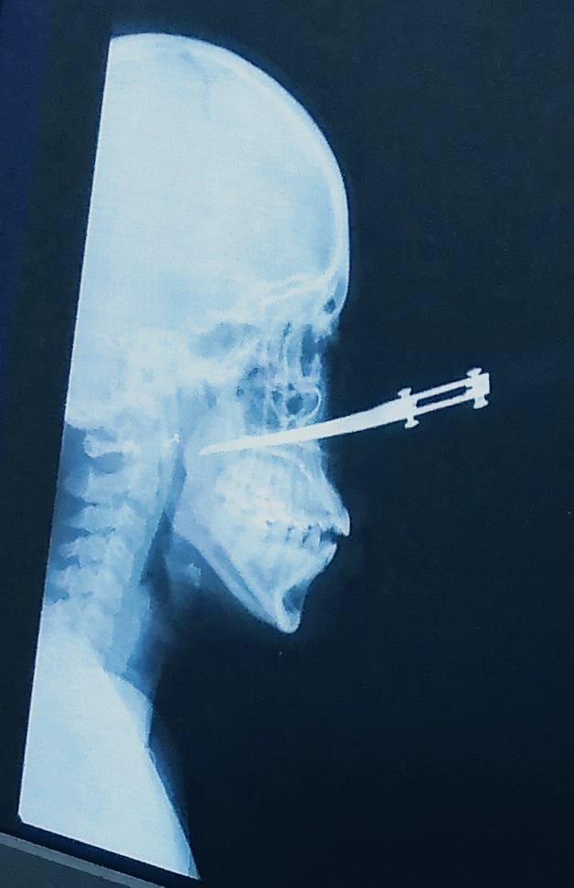 Mujer atacada en el rostro