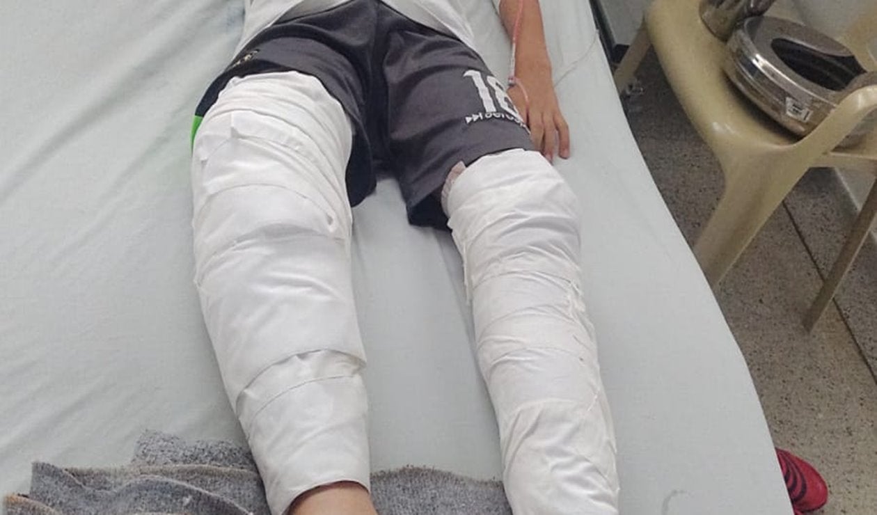 ¡Accidente! En Ibagué niño de 10 años se quemó las dos piernas tras regársele alcohol