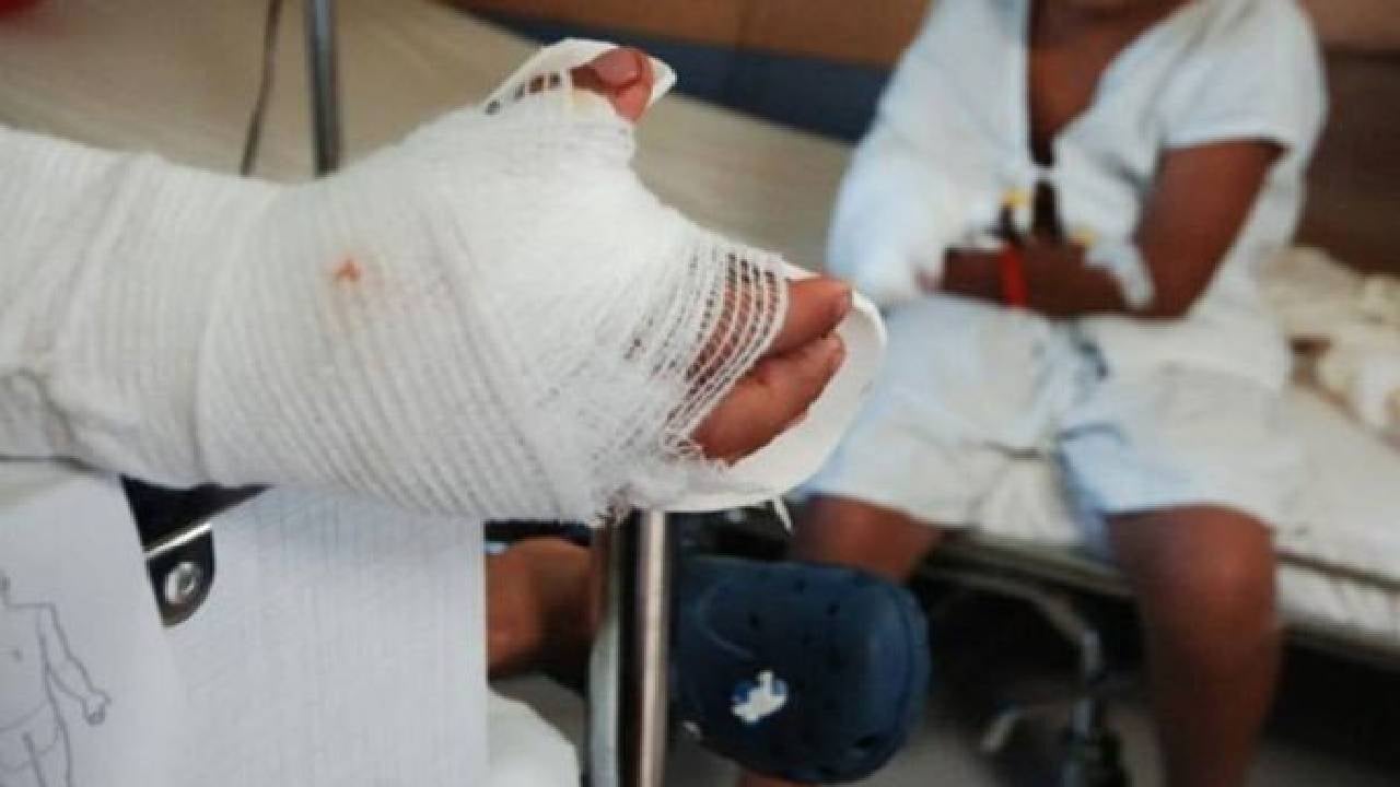 Quemado con Pólvora