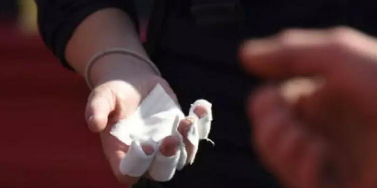 Quemados con pólvora (imagen referencial).