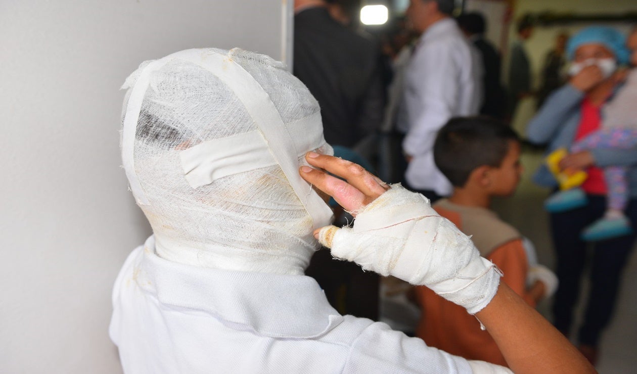 Quemadura con pólvora