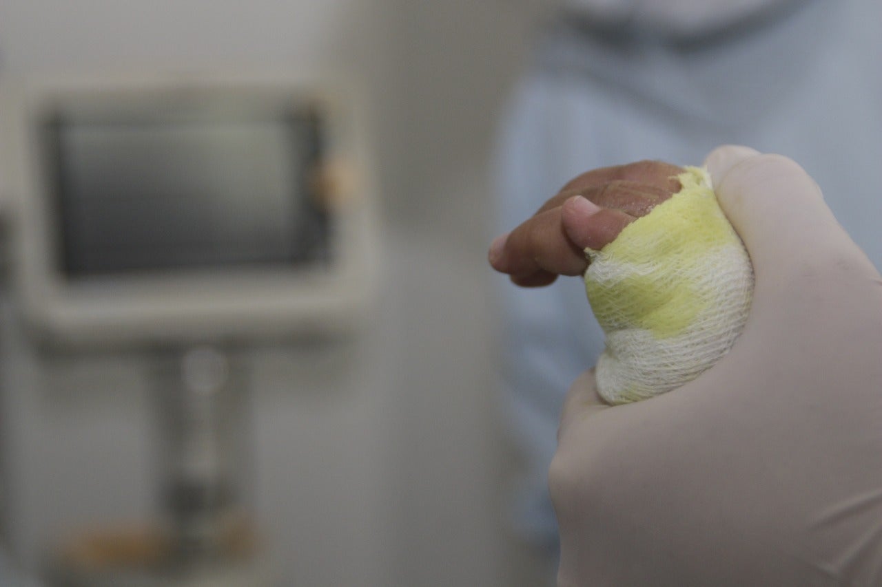 Referencia quemados con pólvora.