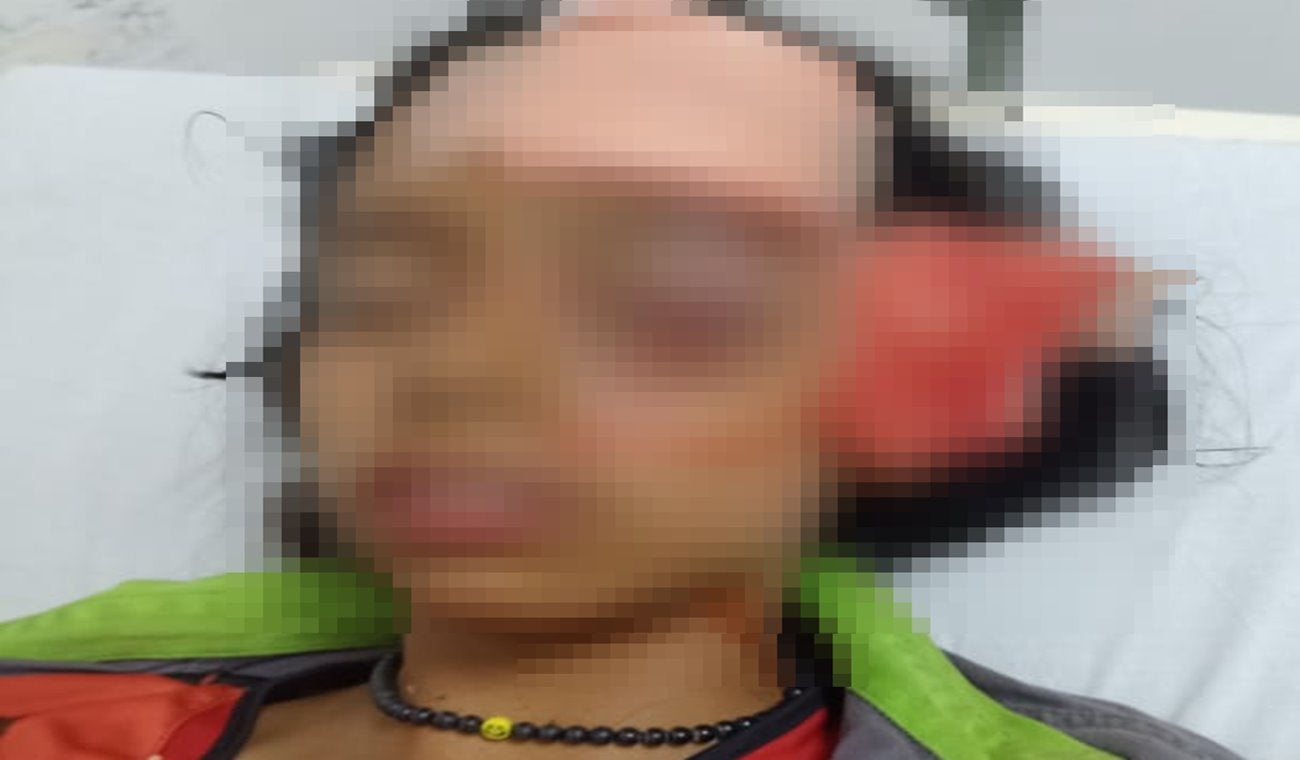 A punta de perder un ojo está niña de 10 años tras brutal ataque de un perro