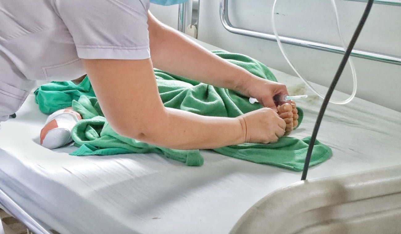 Niño quemado por pólvora