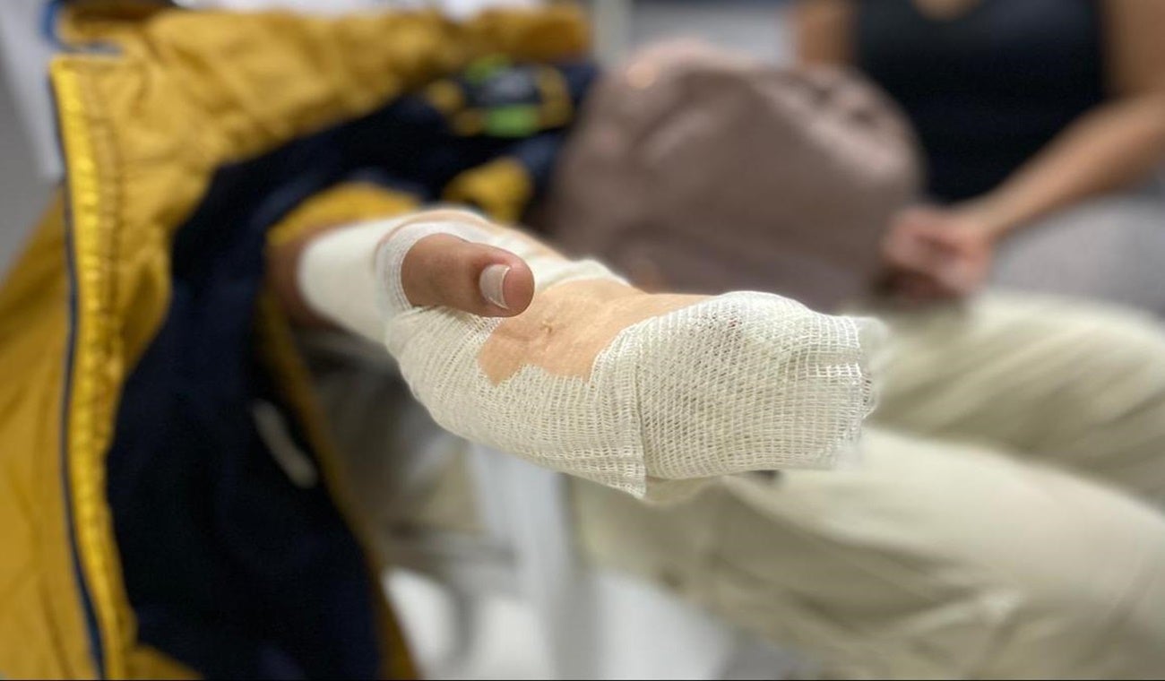 Quemaduras por pólvora en menor