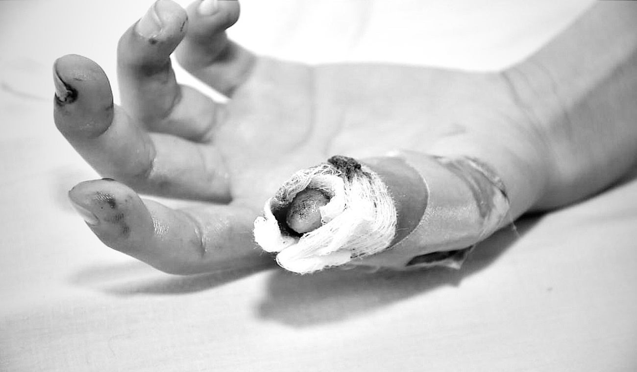 Afectación por artefacto pirotécnico